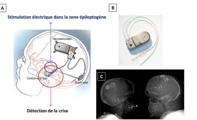 Figure 1 : Système de closed-loop stimulation pour le traitement de l’épilepsie (Responsive Neurostimulation)