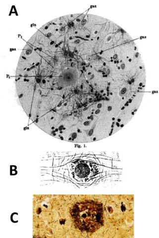 Figure  4  : Dessins des plaques séniles observées dans le cerveau d’Auguste D., réalisés par Dr  Alzheimer  (A,  B),  et  microphotographie  d’une  plaque  sénile  (C)  Adapté  de  (Alzheimer,  1907;  Al zhei mer et al., 1995)  et  http://neuropathology -