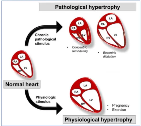 Figure 3. The different phenotypes of cardiac hypertrophy in physiological and pathological conditions  adapted from [29]