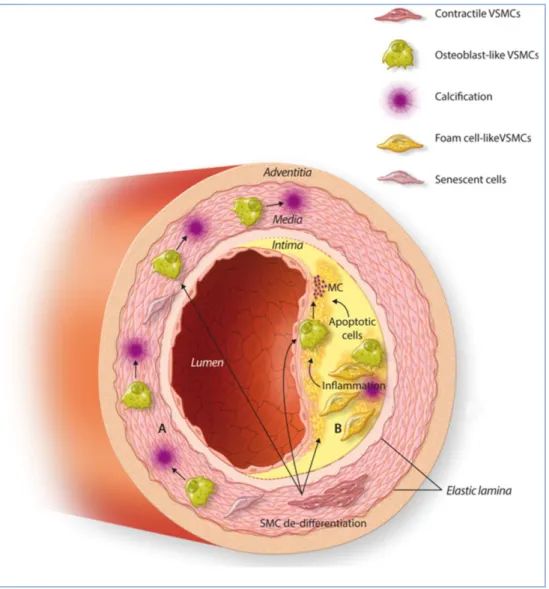 Figure  4.  Schematic  representation  of  an  atherosclerotic  plaque  with  medial  (A)  and  intimal  (B)  calcification, during CKD