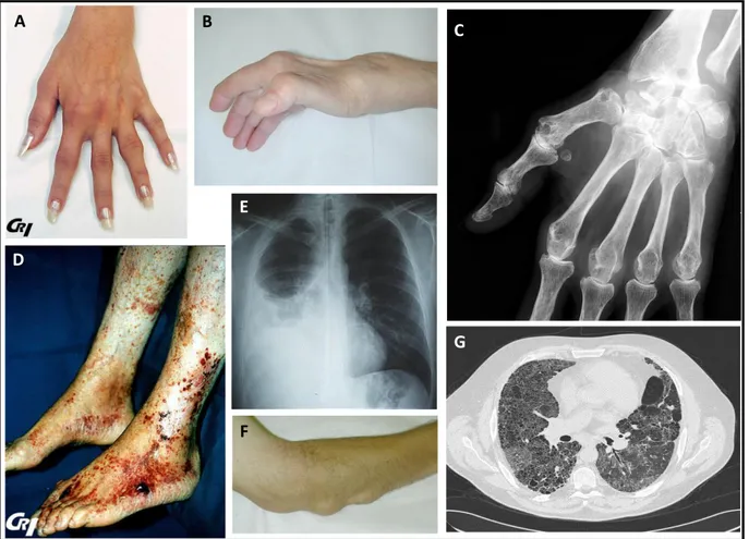 Figure  8.  Atteintes  de  la  polyarthrite  rhumatoïde.  (A)  Arthrites  des  métacarpo-phalangiennes  et  interphalangiennes  proximales