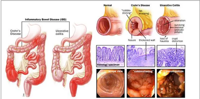 Figure 10 : Anatomopathologie de la maladie de Crohn et de la rectocolite hémorragique