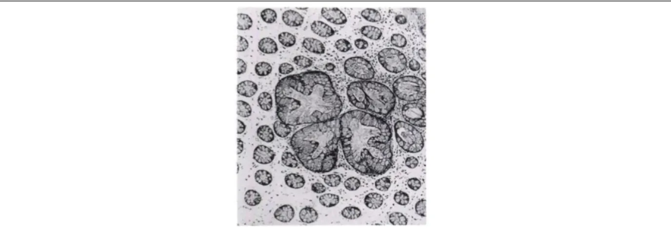 Figure  12 :  Coupe  histologique  d’un  foyer  de  cryptes  aberrantes  coliques  d’un  patient  atteint  d’un  cancer sporadique