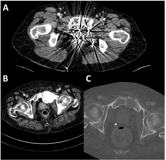 Figure 1 :   Exemples  d’individus  ayant  été  exclus  compte  tenu  d’antécédents  susceptibles  d’interférer avec l’attribution d’un stade : projectiles balistiques de type plomb (1A) et 