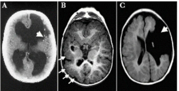 Fig. 5. Anomalies neurologiques dues à une altération du développement du CNS à cause de  l’infection par le HCMV