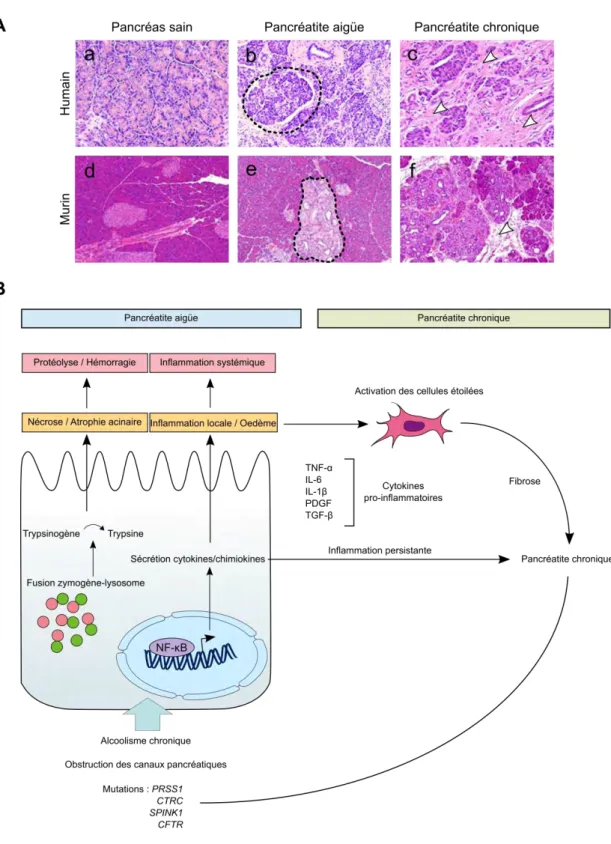 Figure 4 : Mécanismes et caractéristiques histologiques de la pancréatite 