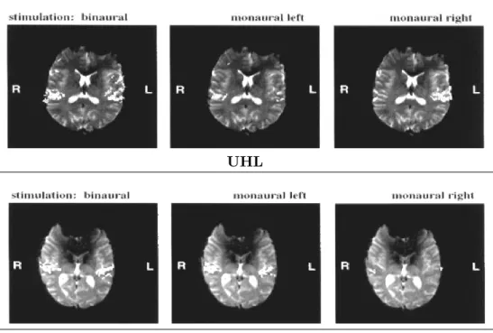 Figure 4.2 – Activation corticale chez un sujet NHL et UHL suite à une stimulation monaurale et binaurale en sons purs