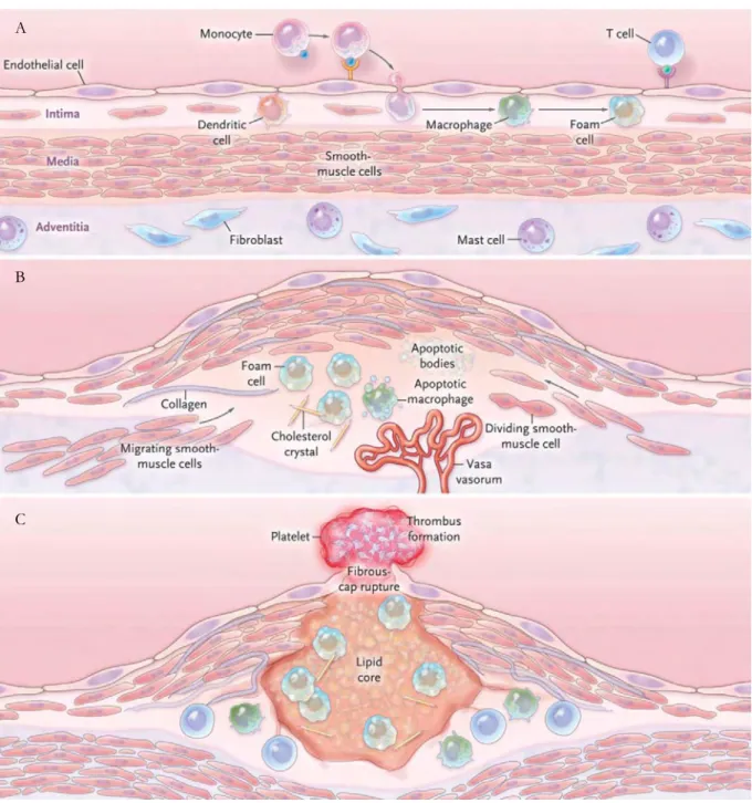 Figure  2  Étapes  de  la  formation  de  la  plaque  d’athérome.  A :  Suite  au  changement  de  perméabilité  de 