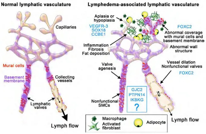 Fig5 :  Principales causes du lymphœdème chez l’Homme.