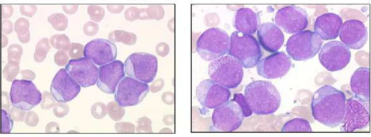 Figure  3  :  Observation  de  blastes  sanguins  et  de  la  moelle  osseuse  au  microscope  à  fond  clair  (Cytochimie de la myéloperoxydase MPO)