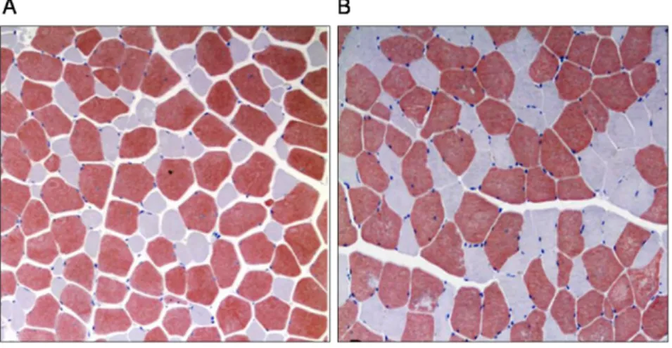 figure  15,  n‟est  pas  spécifique  à  la  sarcopénie  mais  témoigne  d‟une  dénervation  du  muscle que l‟on peut également retrouver au cours d‟immobilisation ou de pathologies  neurodégénératives  comme  la  Sclérose  Latérale  Amyotrophique  (SLA)