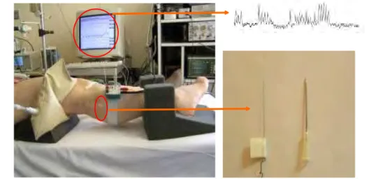 Figure 4 : microneurographie du nerf péroné (MSNA) 