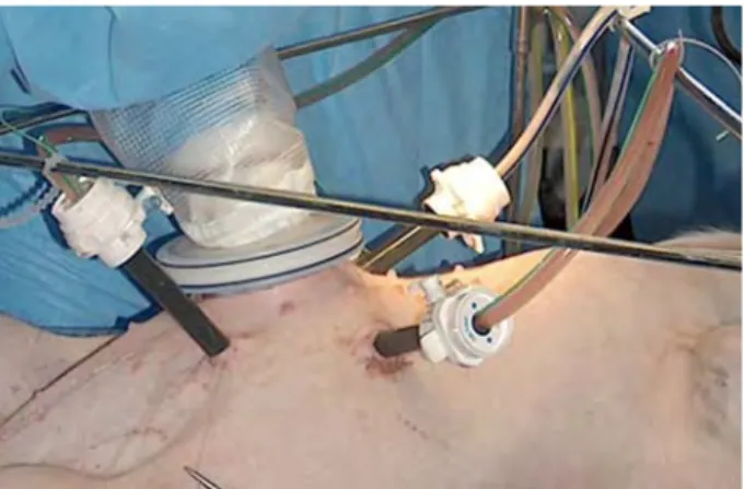 FIG. 1. Positioning of hyperthermic intraperitoneal chemotherapy drains with the surgeon!s hand through the Lapdisc.