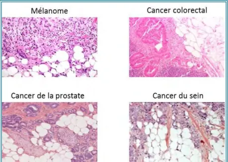 Figure 13. Marquages hématoxyline/éosine du front invasif de mélanome, de cancer colorectal,  de la prostate et du sein