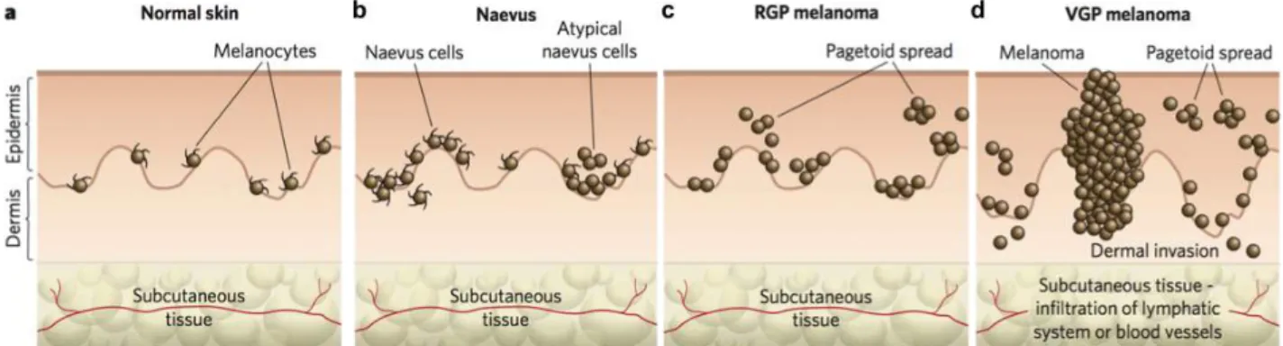 Figure 1 : Les différentes phases de la progression du mélanome (Gray-Schopfer et al, 2007)  a)  Peau  saine  :  Mélanocytes  localisés  sur  la  couche  basale  de  l’épiderme