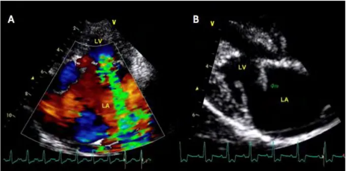 Figure 4. (A) Left parasternal long axis 4-chamber view using the color Doppler mode showing a  severe  mitral  regurgitation
