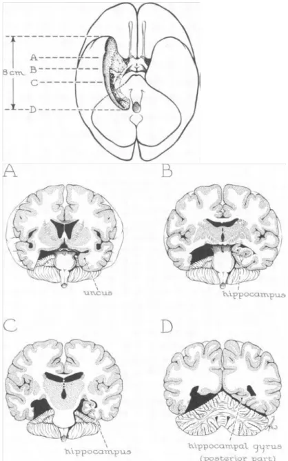 Figure 2 : Schéma d’une résection unilatérale gauche du lobe temporal médian. La zone retirée  est représentée en noir sur les vues transversales