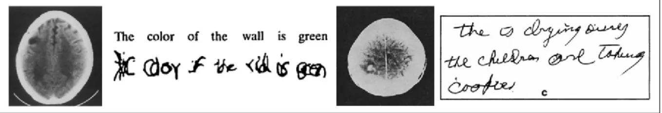 Figure II-3 : Exemple de deux cas d’agraphie apraxique « pure » consécutives à une lésion frontale  prémotrice gauche (à gauche ; Anderson et al., 1990) et pariétale supérieure gauche (à droite ; 