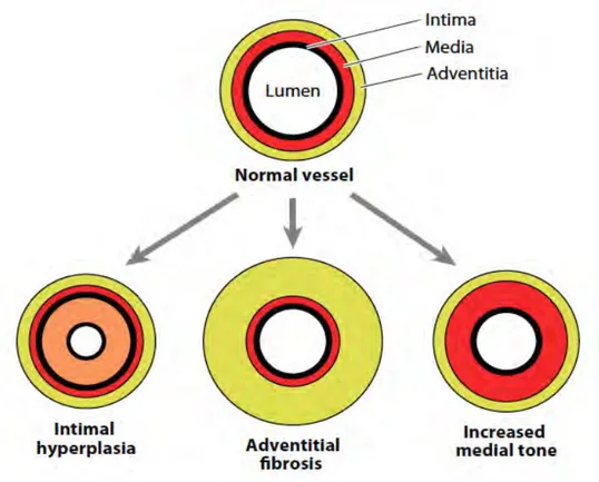 Figure 7.  Les différents remodelages vasculaires observés lors de la VT 