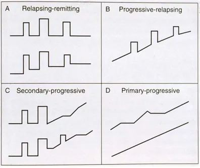 Figure 1.3: MS disease progression may be grouped into four major categories: relapsing-remitting  MS (A), progressive-relapsing MS (B), secondary-progressive MS (C) and primary-progressive MS 