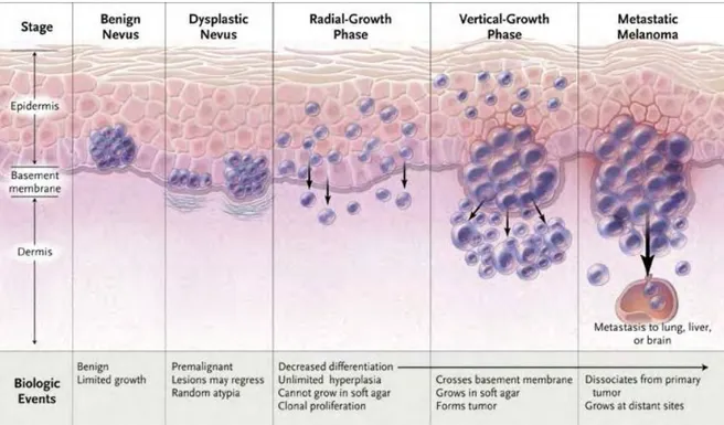 Figure 3 : Schéma de progression du mélanome selon le modèle de Clark 