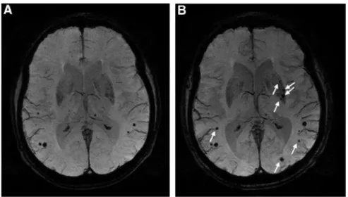 FIGURE 7 : APPARITION DE NOUVEAUX MICROSAIGNEMENTS EN T2* AU COURS DU SUIVI D’UN PATIENT