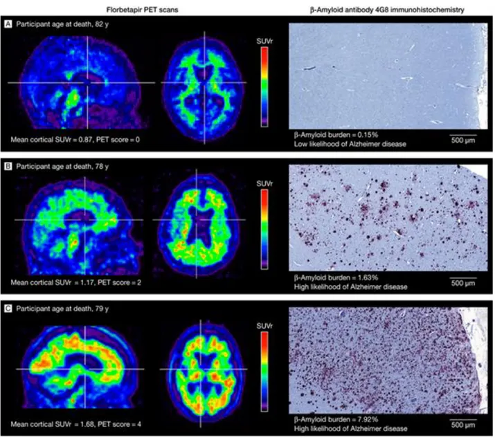 FIGURE 9 : COUPES SAGITTALES ET AXIALES DE TEP SCANNERS DE SUJETS REPRESENTATIFS