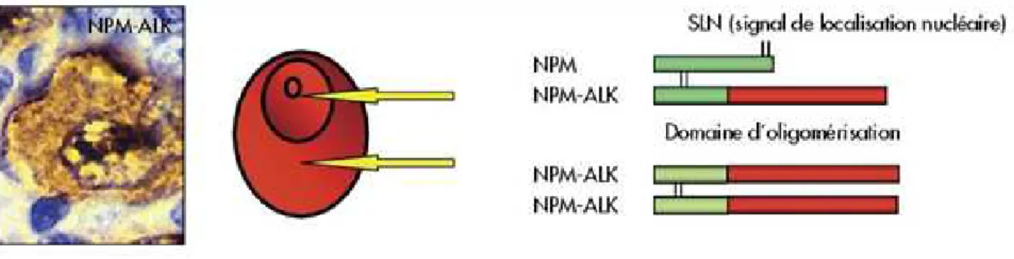 Figure 4: Localisation subcellulaire de la protéine de fusion NPM-ALK. 