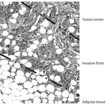 Fig. 1.  Mature adipocytes are present in breast tumor stroma. Histologic examination of a breast  tumor (HE, orig