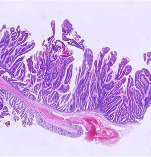 Figure 5. Adénome villeux sessile du 
