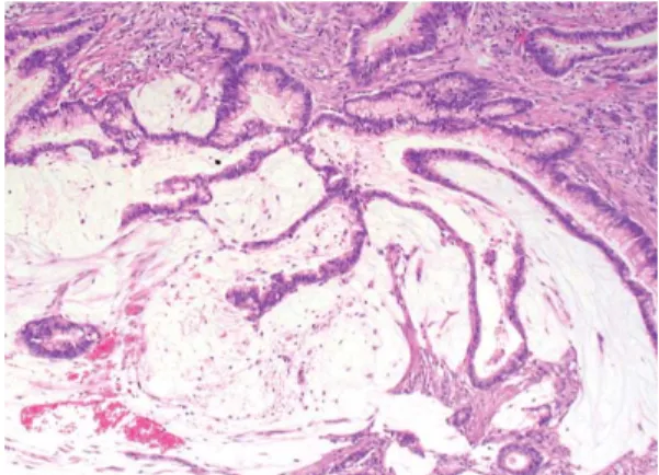 Figure  9.  Adénocarcinome  mucineux  bien 