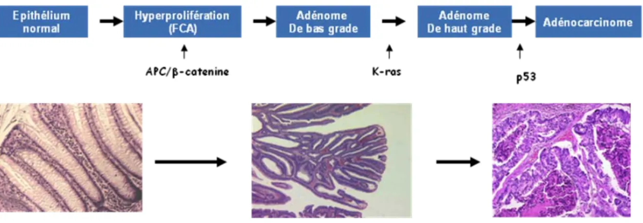Figure  17.  Séquence  adénome-carcinome  classique.  Les  mutations  APC  initient  le  processus 