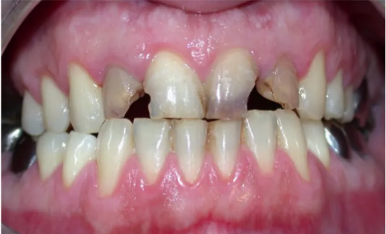 Figure 9 : Lésions carieuses importantes sur les incisives maxillaires (Dr Savard) 