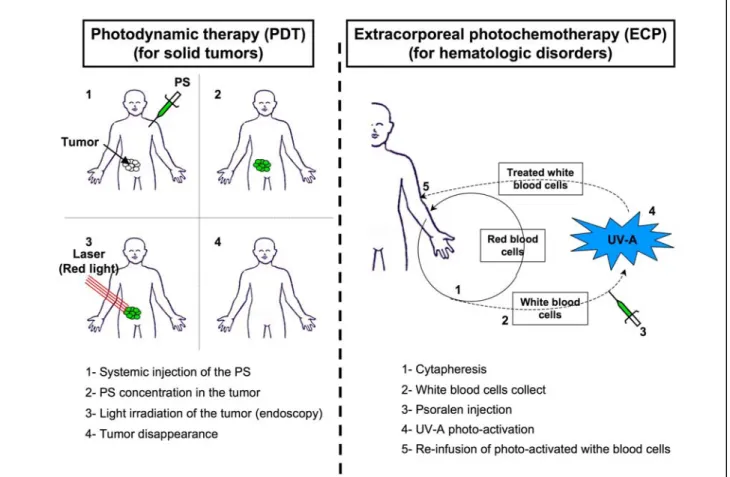 Figure  11 :  Schémas  protocolaires  des  techniques  de  traitement  des  cancers  par  photochimiothérapie 