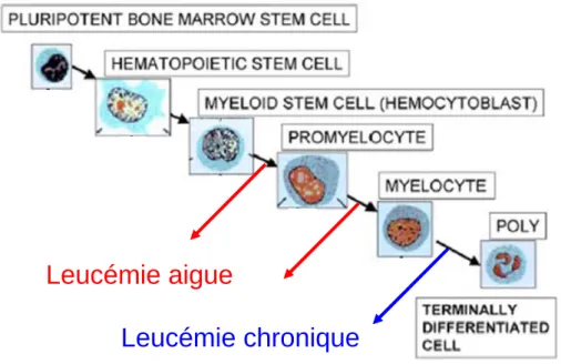 Figure 13 : Les leucémies