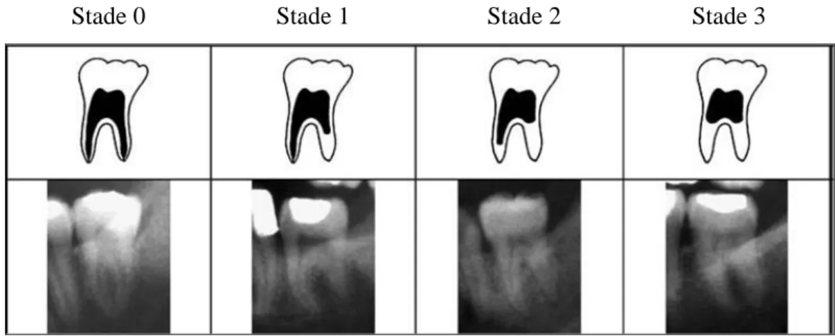 Figure 9. Schémas et radiographies montrant les stades de visibilité de la pulpe radiculaire sur une  troisième molaire (Olze et al., 2010) 