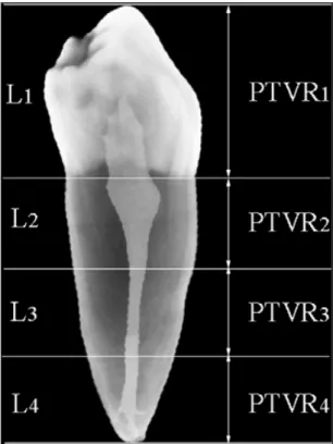 Figure 12. Reconstruction de l'image d'une prémolaire mandibulaire montrant les zones utilisées  pour les mesures volumétriques (Aboshi et al., 2010) 