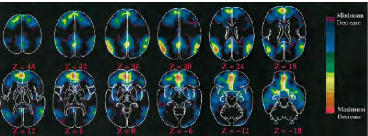 Figure 7. Débit sanguin cérébral au repos enregistré en TEP H 2 O 15 . 