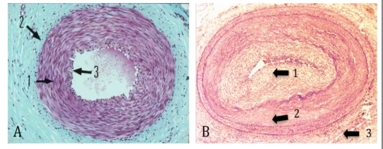 Figure  4  :  Coupe  histologique  d’artère  saine  et  d’artère  présentant  des  lésions  de 