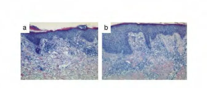 Figure 16- Phénotype histologique de la dermatite atopique. 