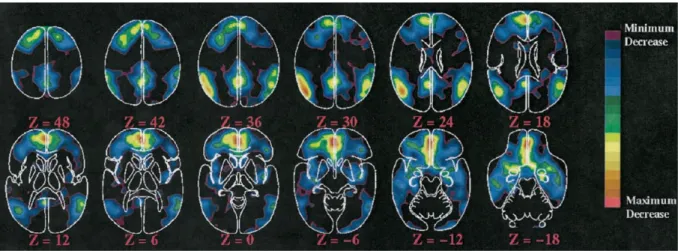 Figure  1:  Régions  du  cerveau  montrant  habituellement  une  diminution  de  leur  activité  au  cours  d’une  tâche  active