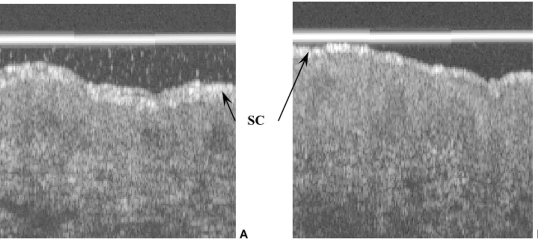 Figure 17: Images OCT illustratives de la différence de l'épaisseur du SC, (A) avant et (B) après stripping (Gx2,5)