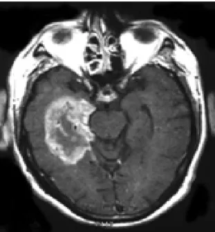 Figure 1 :  Glioblastome Multiforme observé par IRM au niveau du lobe temporal.  
