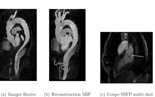 Figure 2.3  Séquence à eet angiographique (ARM 3D), coupe native et reconstruc- reconstruc-tion MIP sur une dissecreconstruc-tion chronique de l'aorte descendante