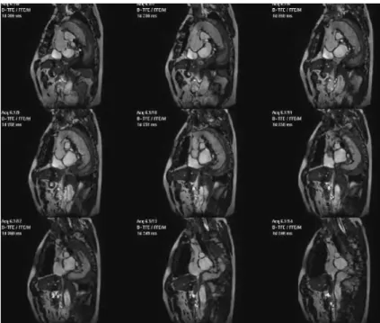 Figure 2.9  Séquence destinée à observer la dynamique de la paroi eectuée sur le même patient avec deux Stent-Grafts
