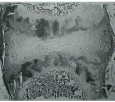 Fig. 12 : Section parasagittale  du corps vertébral d’un  nouveau né. Le DIV a une  forme biconcave