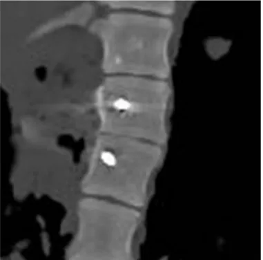 Fig  3.1   Tomodensitométrie  permettant  le contrôle du positionnement correct de  la vis pédiculaire 
