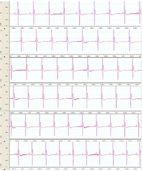 Figure 1.6 : Exemple chez une souris d’un tracé électrocardiographique  témoignant de la présence de troubles conductifs transitoires à l’issue du 