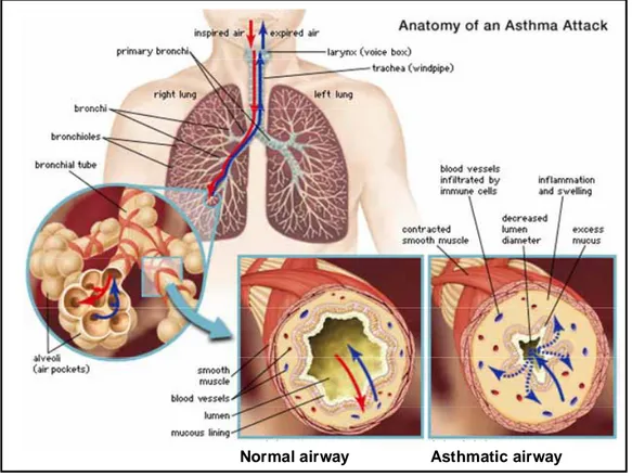 Fig. 1.3.  Comparison of the airway in asthma patient with normal airway. (Encyclopædia 