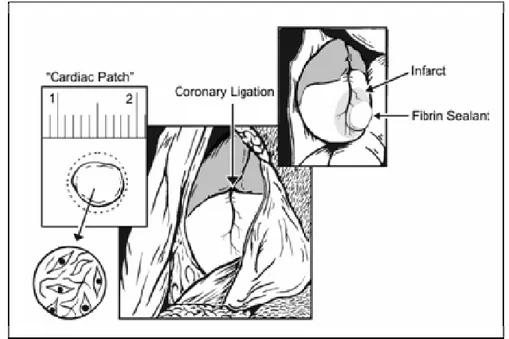 Figure 6 : Schéma de l’implantation d’un  « patch » au niveau d’un infarctus du myocarde  (Simpson et al